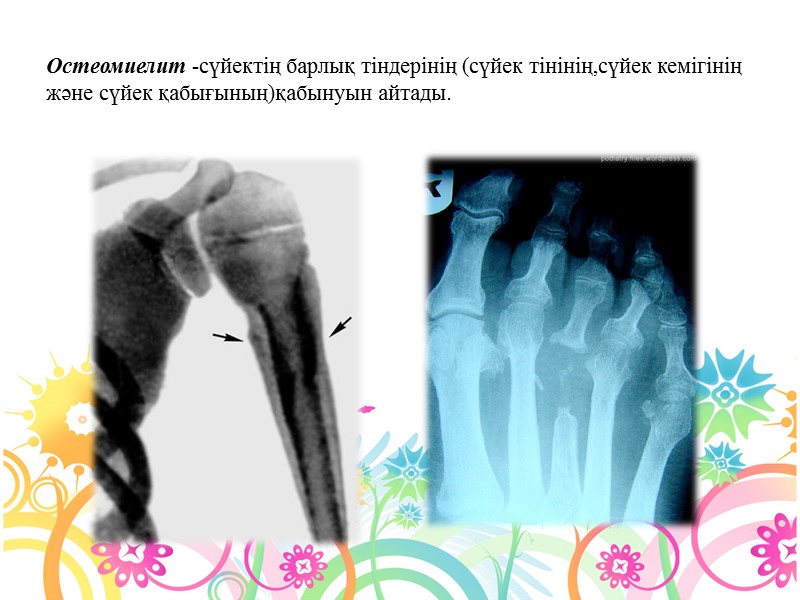 Остеомиелит -сүйектің барлық тіндерінің (сүйек тінінің,сүйек кемігінің және сүйек қабығының)қабынуын айтады.